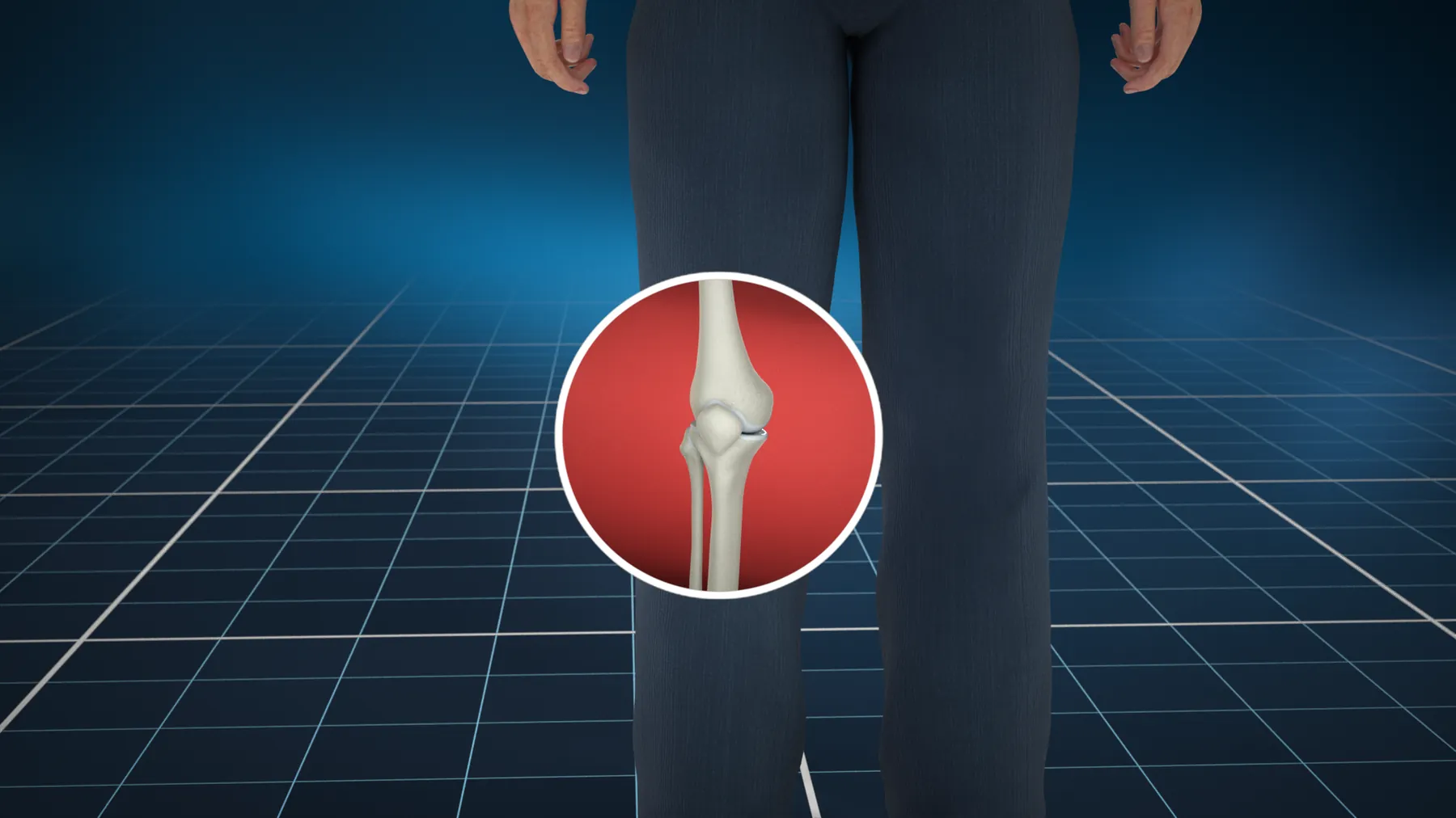 Tendoplus ACL Therapy — image 1