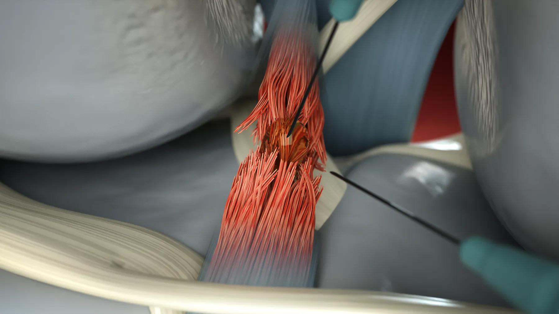 Tendoplus ACL Therapy — image 8
